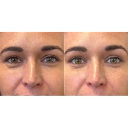 Plump It! No Needles Dermal Filler 15 stk x 0,67 ml