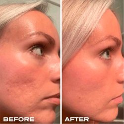 Plump It! No Needles Dermal Filler 15 stk x 0,67 ml