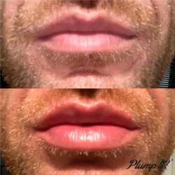 Plump It! DUOST No Needles Lip FILLER Kit 2x3 ml