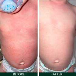 Sorted Skin Intensive Rescue Spray 100 ml